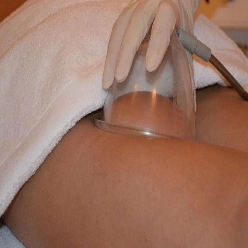 Точечный лифтинг (паук)