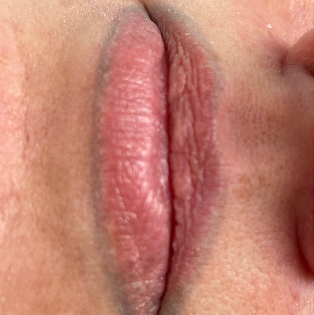 Удаление лазером