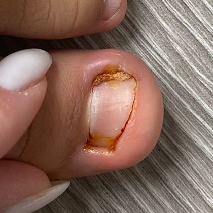 ТАМПОНИРОВАНИЕ