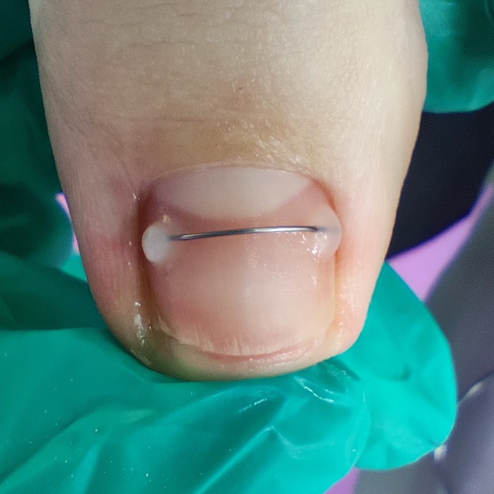 Установка корректирующей системы. Титановая нить