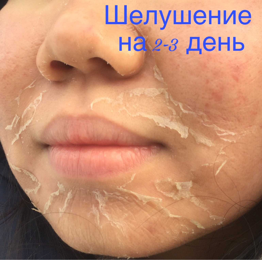 Пилинг Джесснера