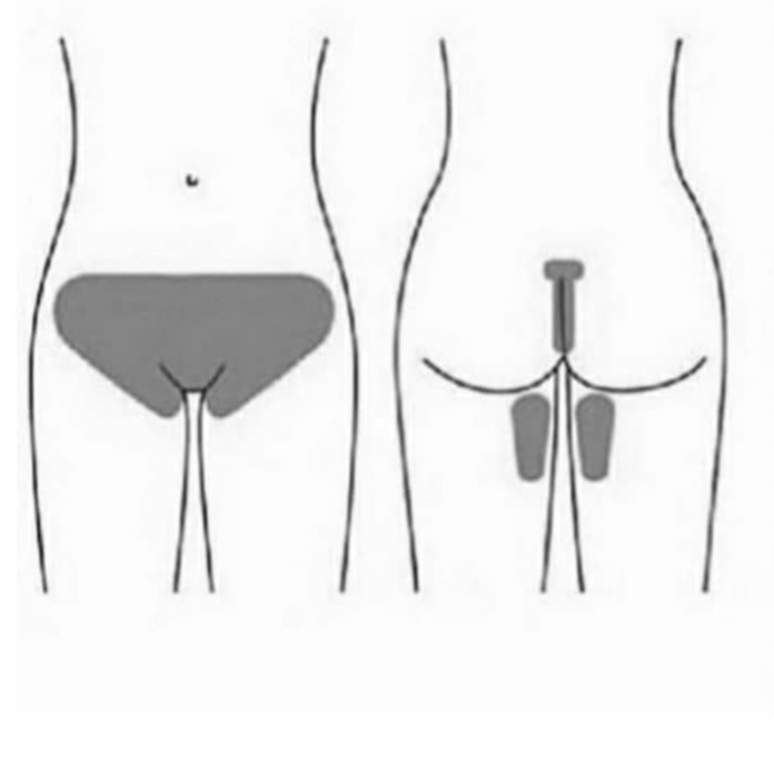 Бикини тотальное (шугаринг)