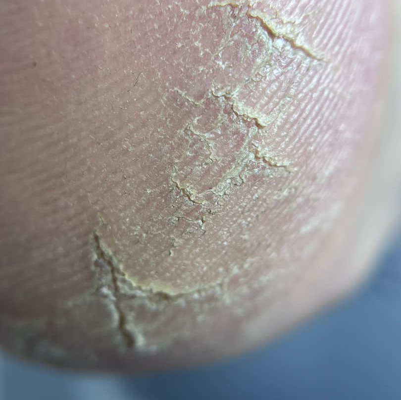 Педикюр повышенной сложности +300₽ (трещины, гиперкератоз, ксероз, деформированные утолщенные ногти)