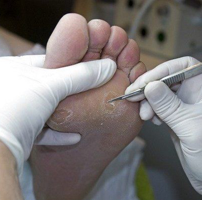 Обработка мозоли