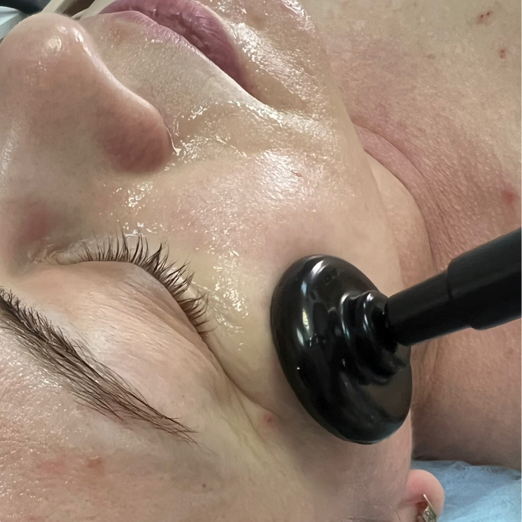 Глубокий лифтинг лица  Индиба