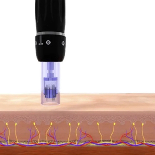 PMP -терапия с фракционным микронидлингом