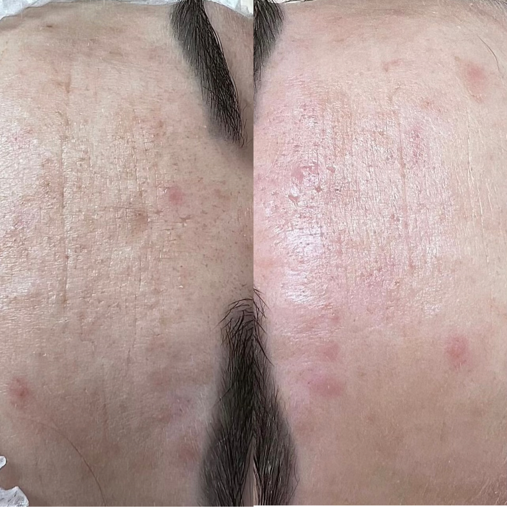 Комбинированная чистка лица