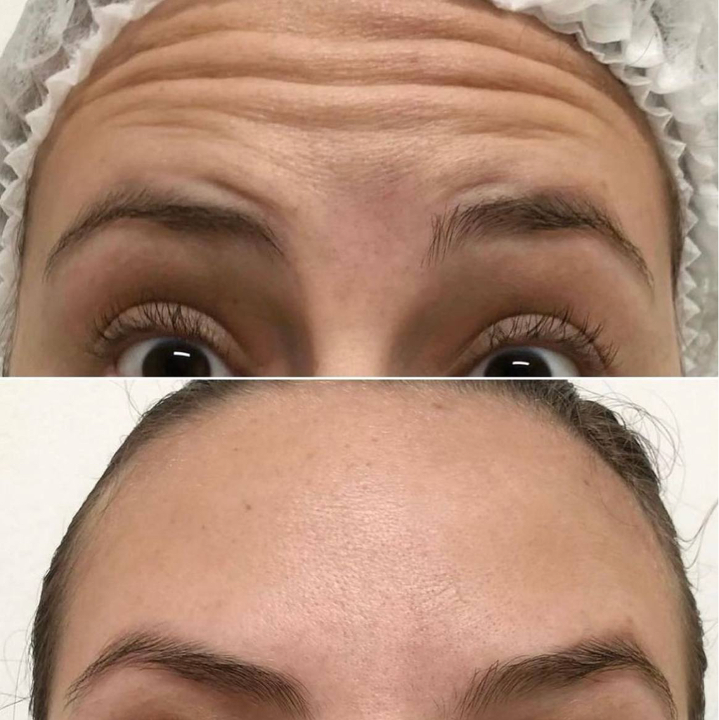 Ботулинотерапия