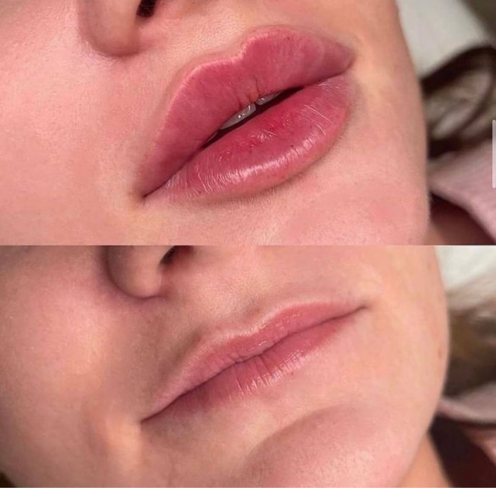 Увеличение губ