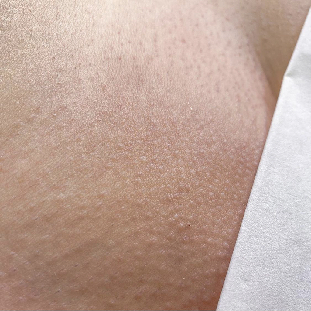 Депиляция глубокого бикини