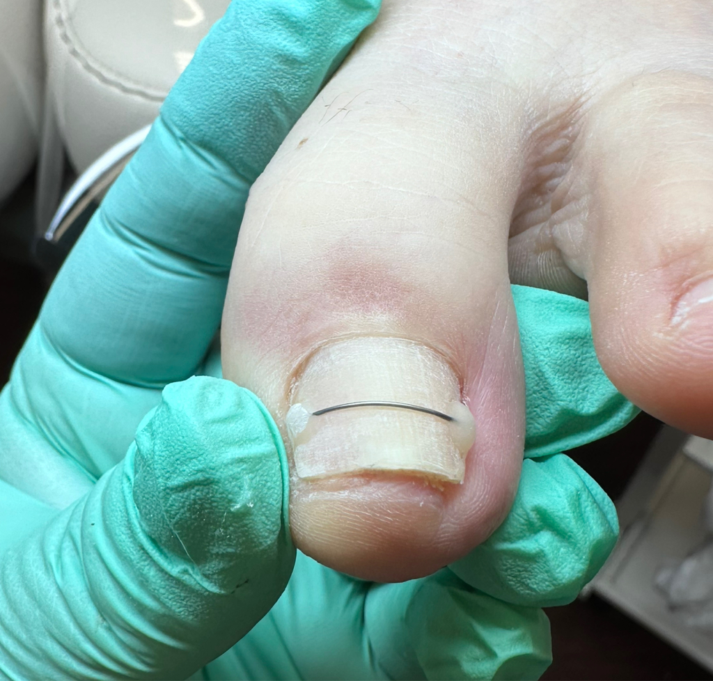 Постановка титановой нити