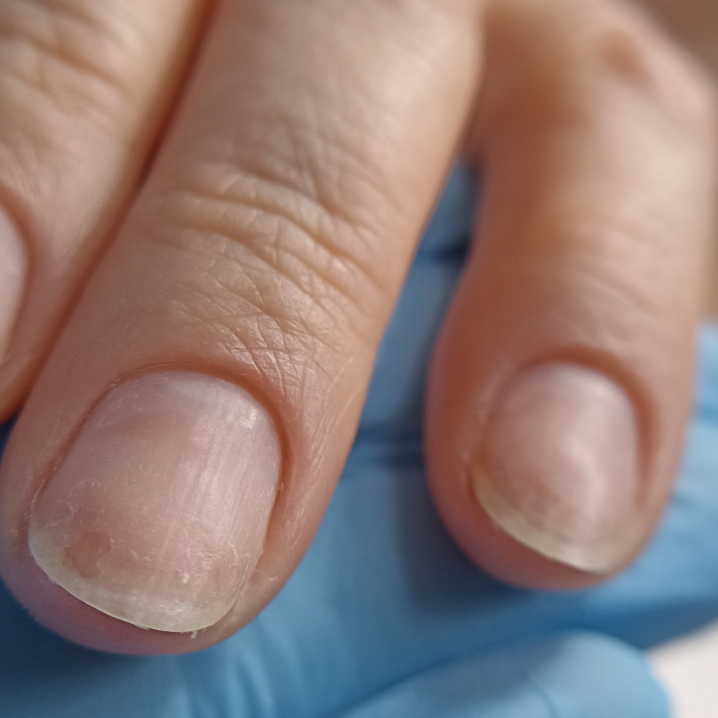 Снятие покрытия