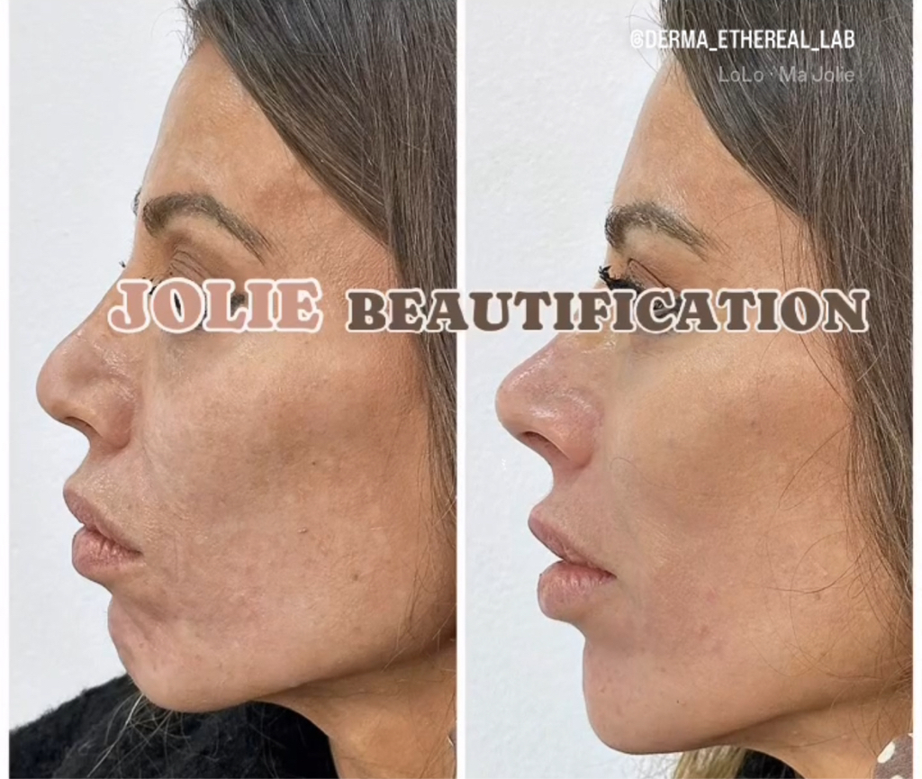 BEAUTIFICATION:  ANGELINA-JOLIE FACE&BODY  Διόρθωση ατέλειες  4 θεραπειες (Ανόρθωση και λίφτινγκ)