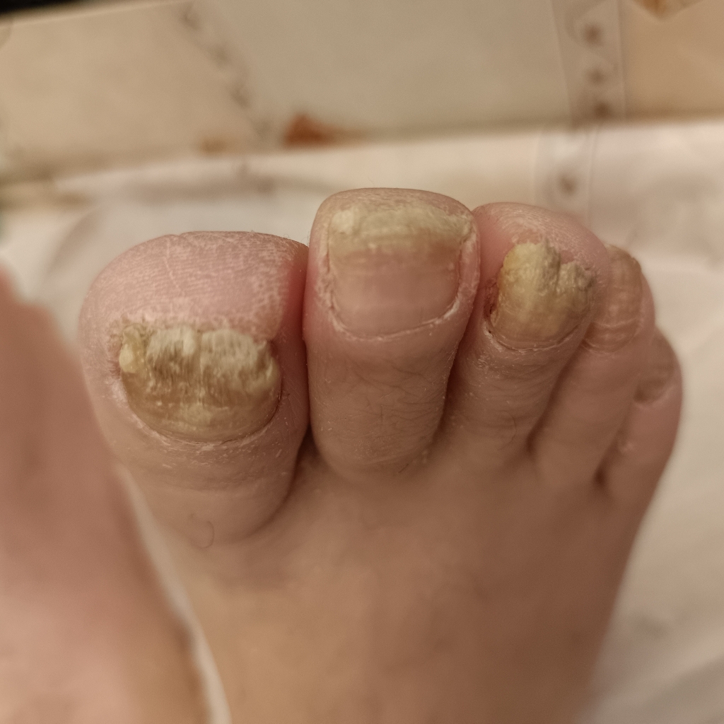 комплексный педикюр при поражении грибком