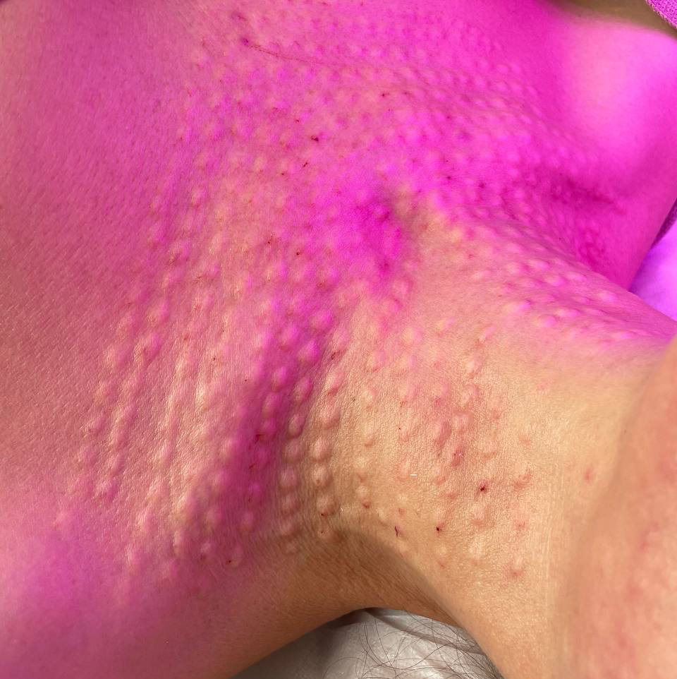 Биоревитализация