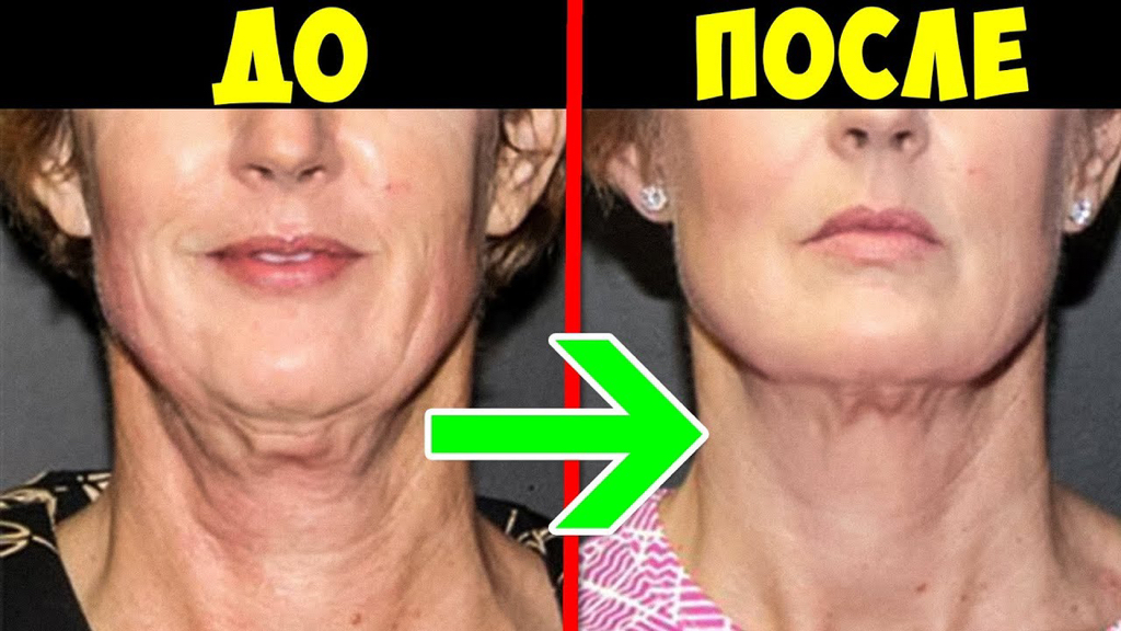 Фракционное лазерное омоложение (шея)