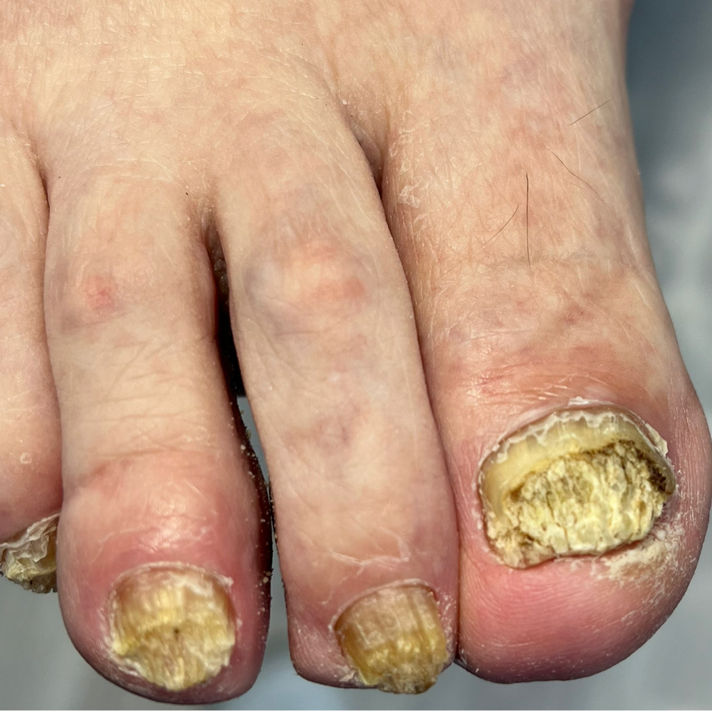 Зачистка грибковых поражений ногтей, онихогрифоза, онихолизиса и пр. деформаций ногтевых пластин