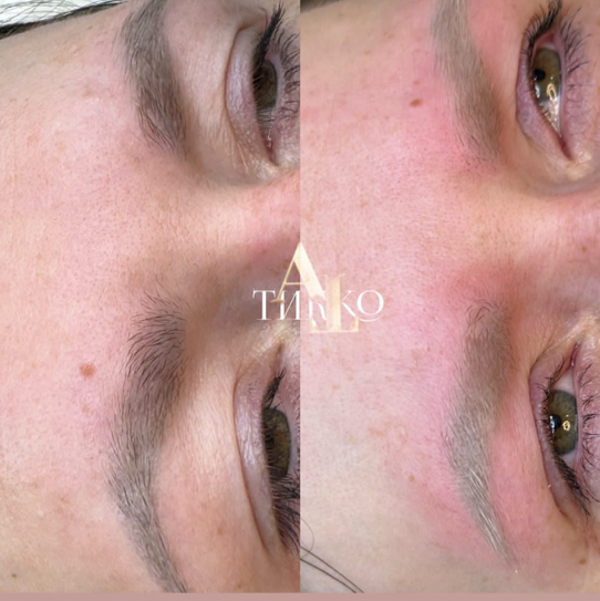 Лазерное удаление татуажа (любой зоны)