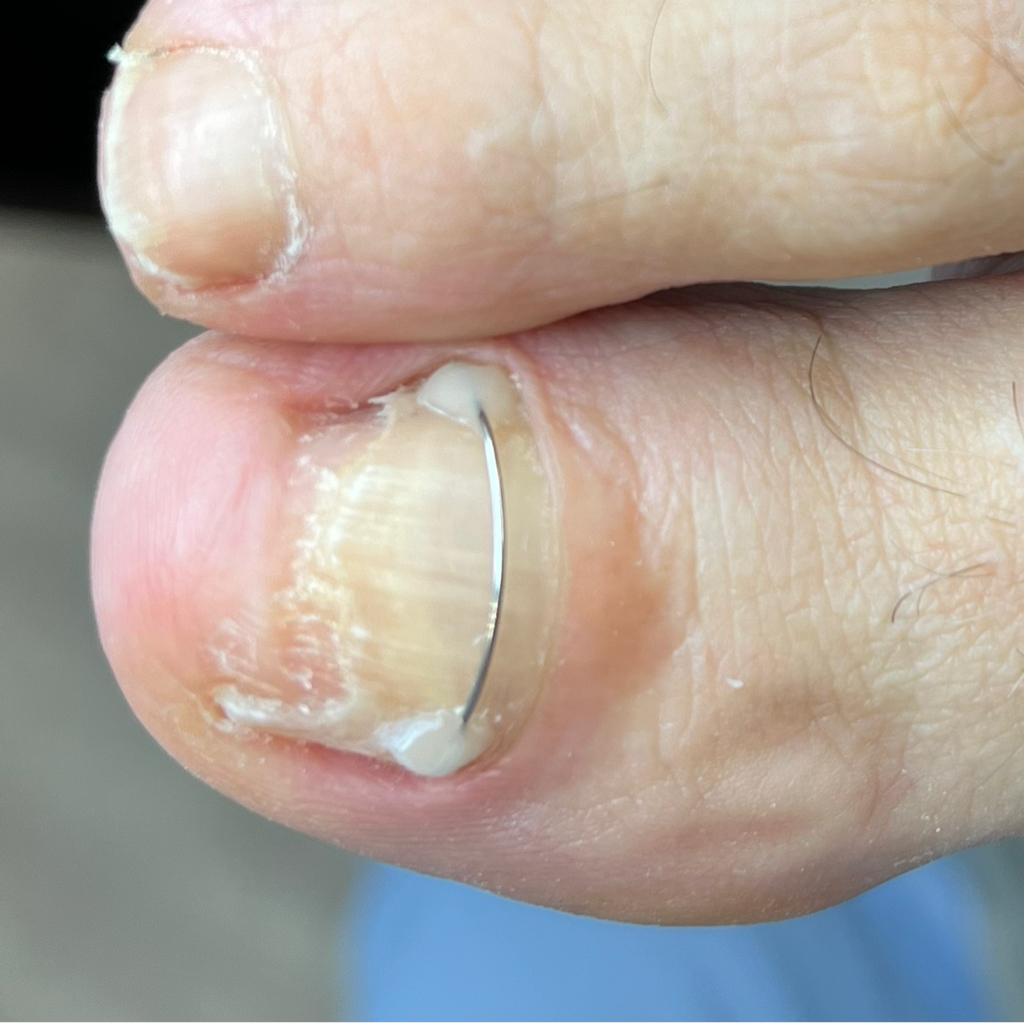 Коррекция уже установленной титановой нити.