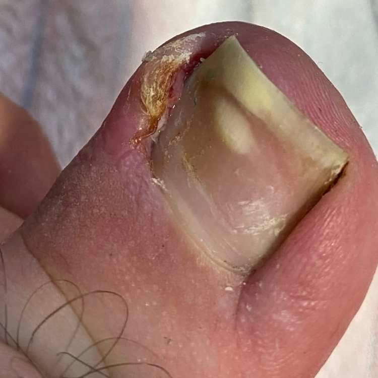 Обработка вросшего ногтя, удаление вросших сегментов(без установки коррекционных систем)