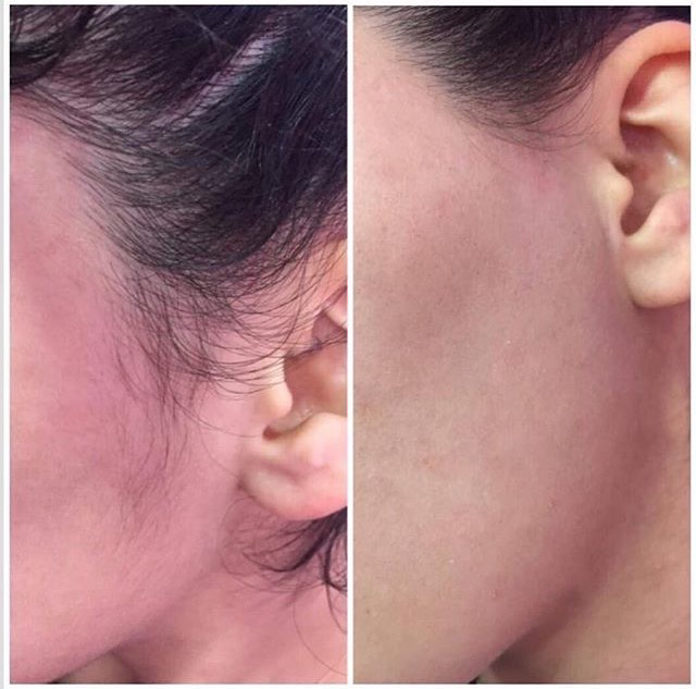 Удаление волос на лице  (Усики, шея, подбородок)