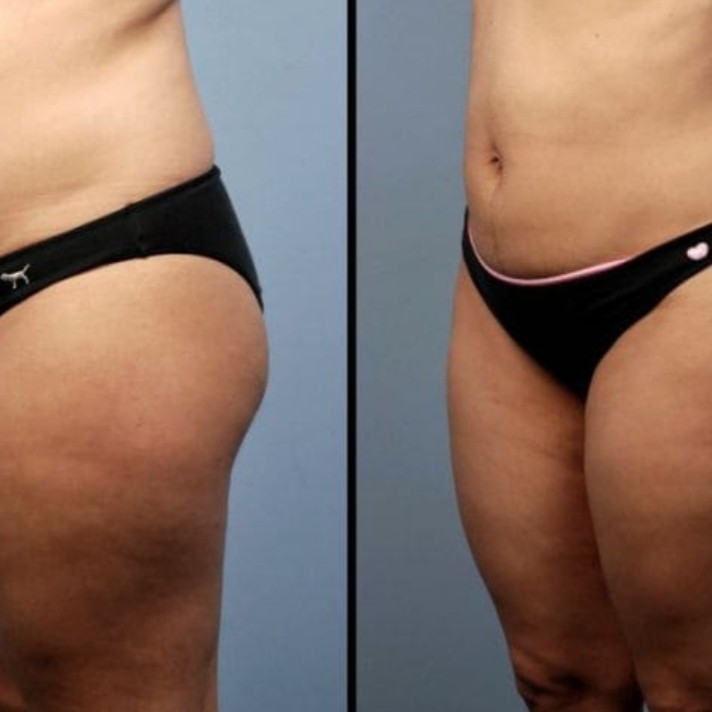 Ультразвуковая кавитация