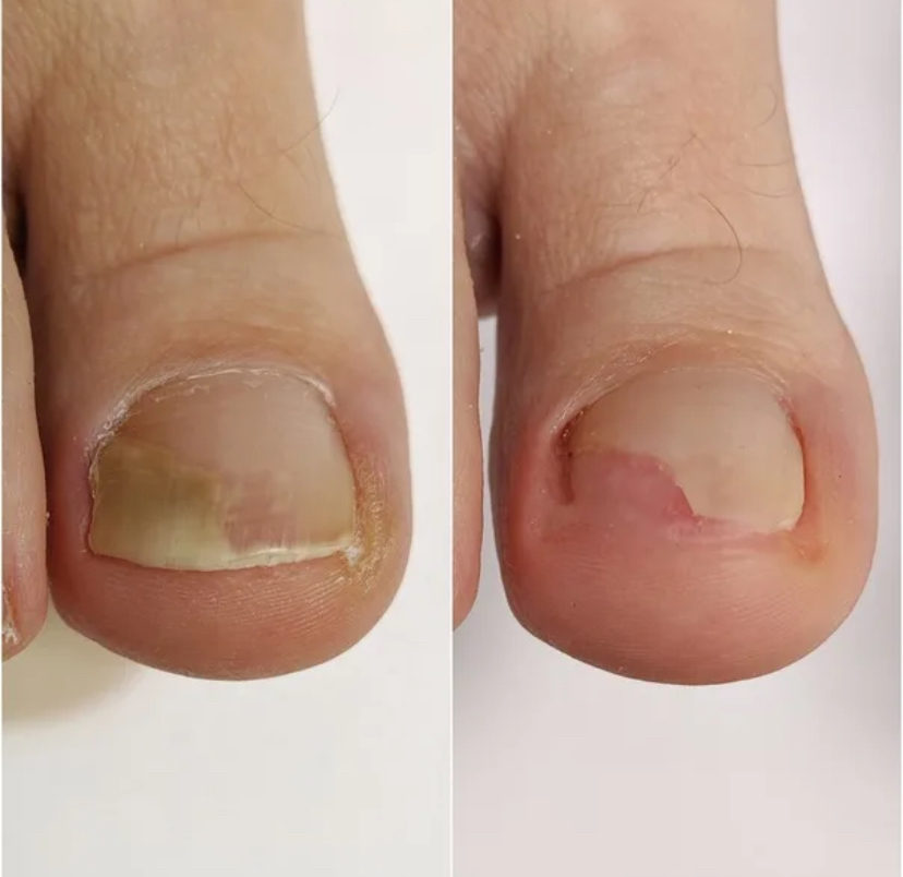 Зачистка онихолизиса ( один )