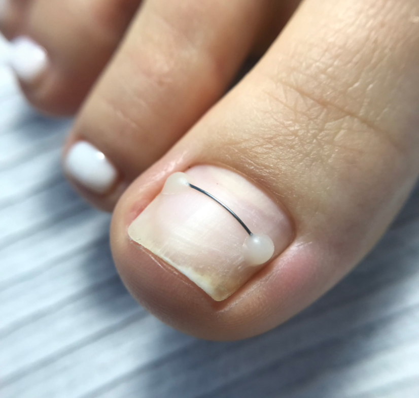 Коррекция титановой нити ( два ногтя )