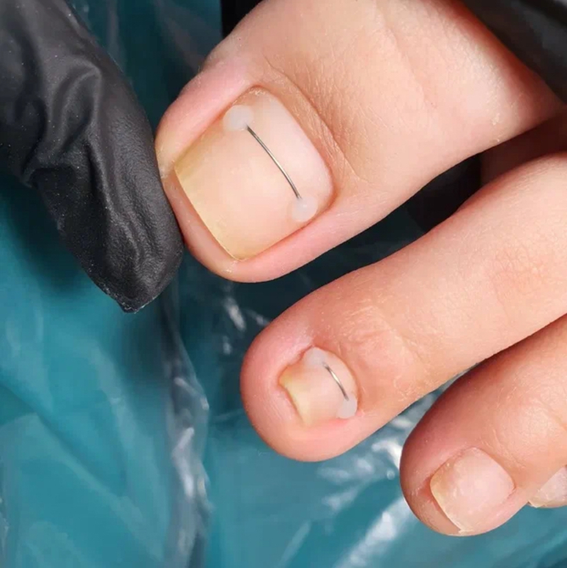 Коррекция титановой нити ( один ноготь )