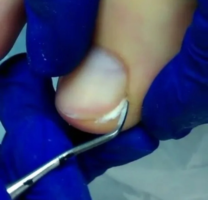 Тампонирование ( 1 ноготь )