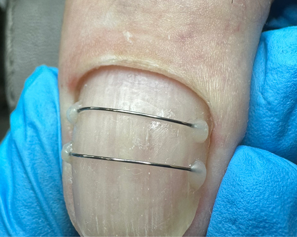 Установка титановой нити(большой палец)-корректирующая система от скручивания и врастания ногтевой пластины.