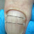 Установка титановой нити(большой палец)-корректирующая система от скручивания и врастания ногтевой пластины.