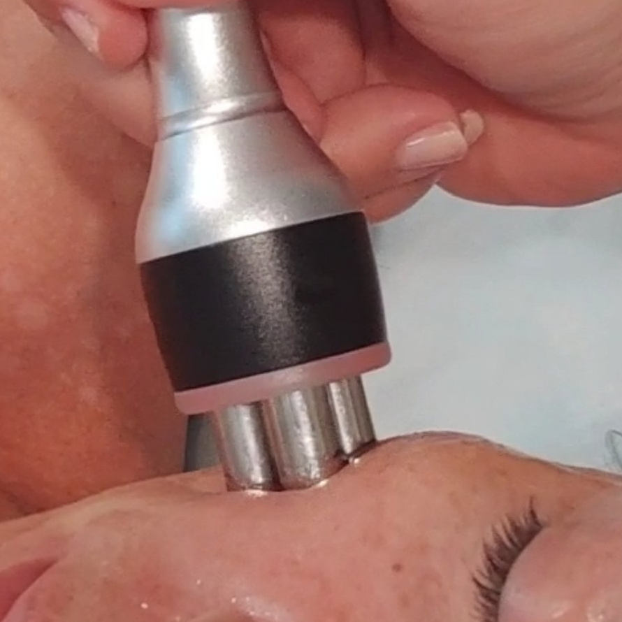 RF- лифтинг лицо