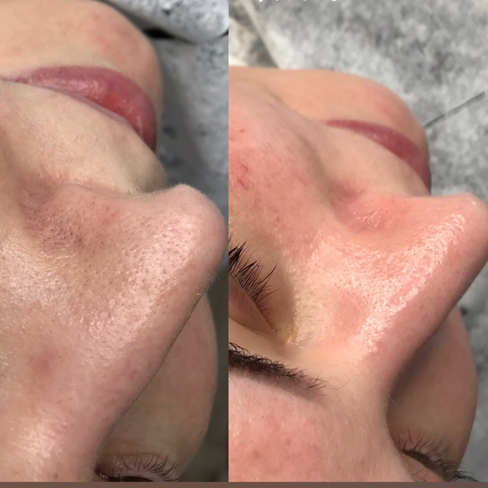 Чистка лица на GIGI