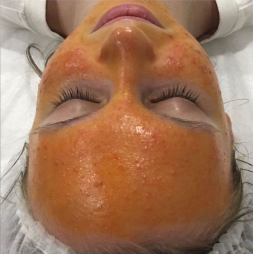 RETISES CT Yellow peel Пилинг желтый+ Вит C ( Mediderma-Испания)