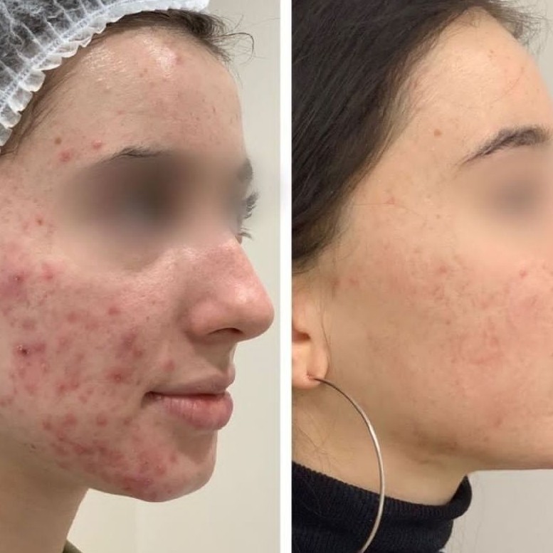 Уходовая процедура для лица по типу кожи ( чистка/ пилинг/маски/карбокси/массаж/ комбо )