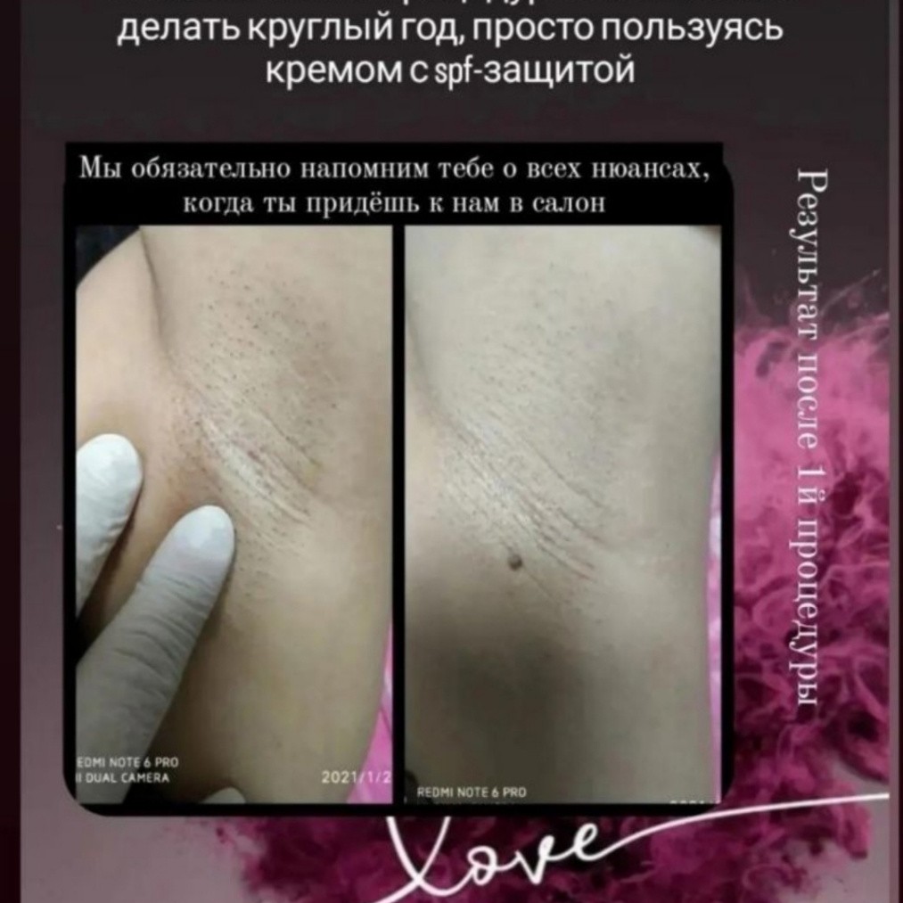 Подмышки