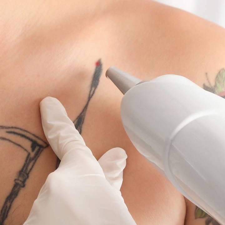 Лазерное удаление татуировки