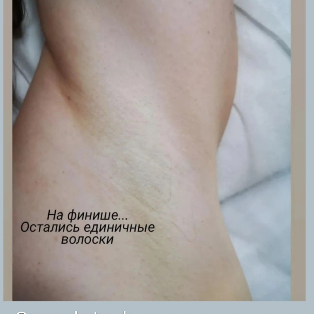 Электороэпиляция тела