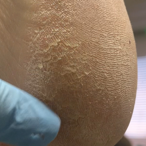 Обработка проблемных стоп