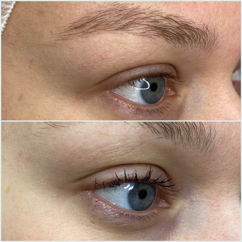 BioGel PDRN eyes. Мезотерапия глаз
