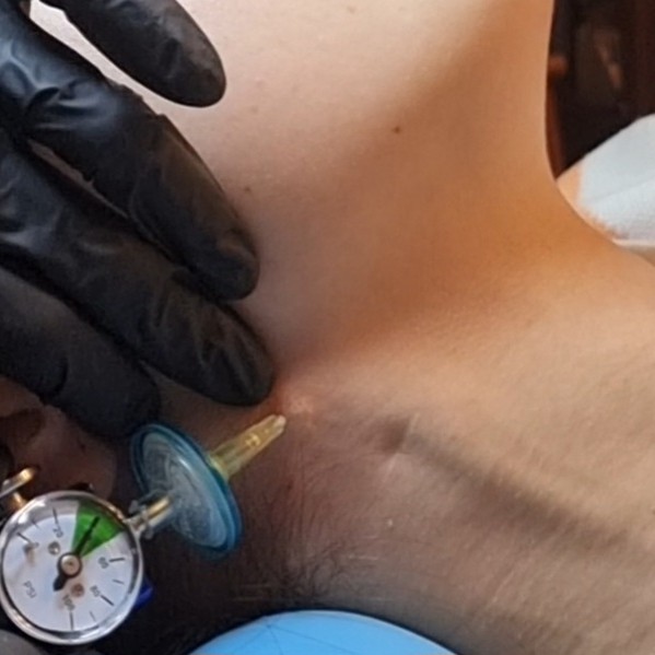 Карбокситерапия 1 зоны тела (инъекции)