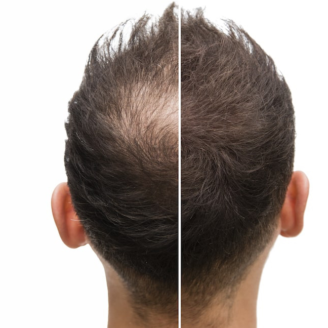 Consultation for Scalp Micropigmentation