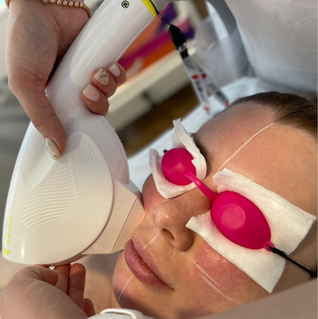 PhotoFacial / Skin Rejuvenation (IPL)