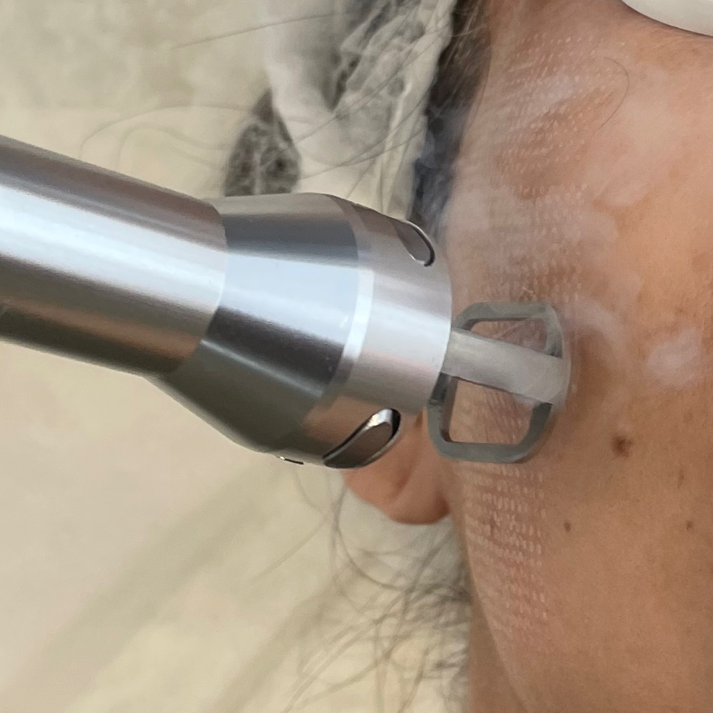Fraxel Laser Skin Resurfacing Face