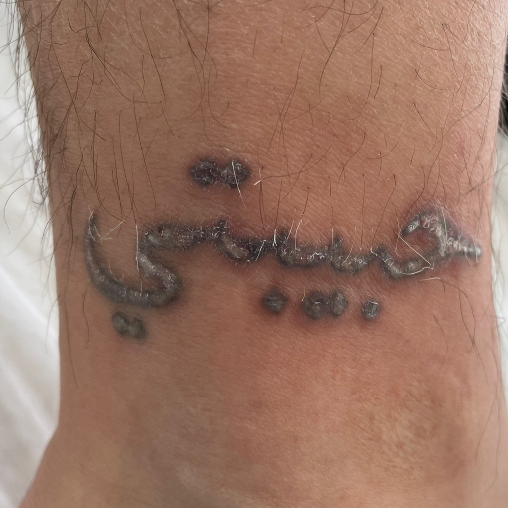 Laser Tattoo Removal