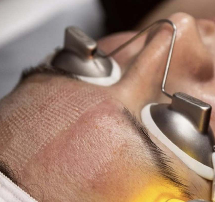 Fraxel Laser Skin Resurfacing Face & Neck