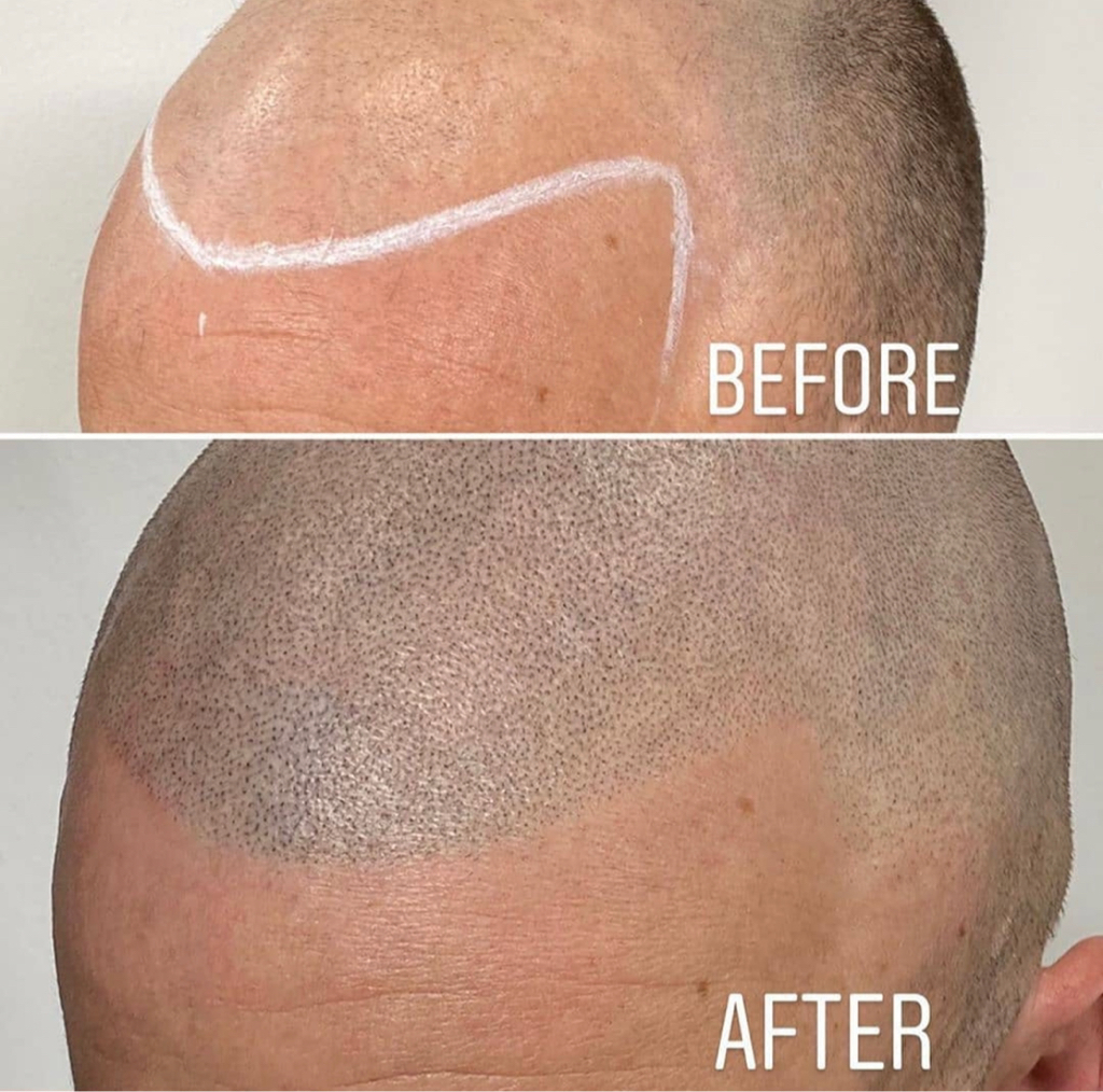 Scalp Micropigmentation 4 hours