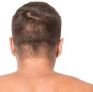 Hair line wax (neck)