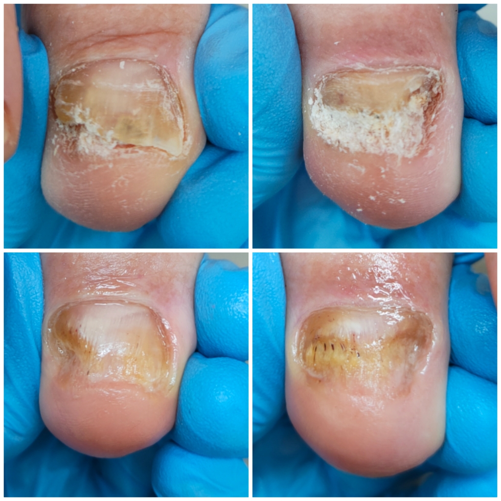 Обработка ногтей с признаками грибка, все пальчики